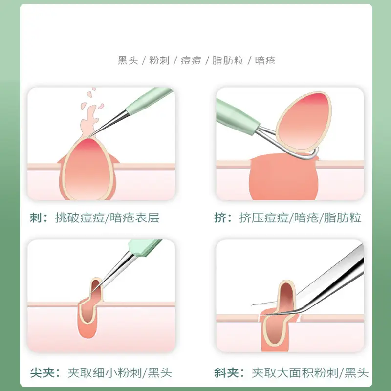 5-Piece Acne Clip & Needle Set for Blackhead Removal