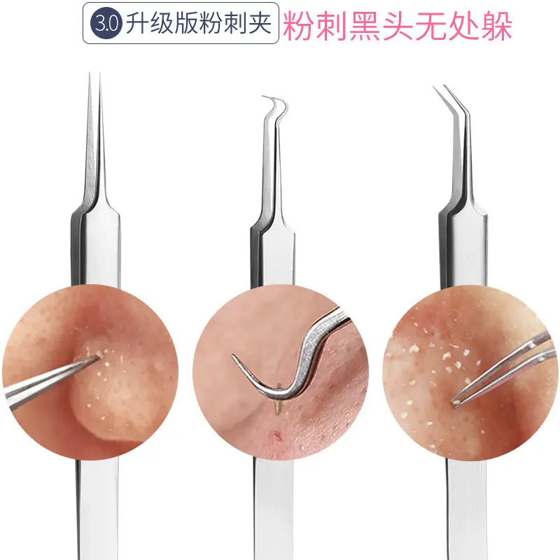 Acne Removal Double-Headed Acne Squeezer Tweezers - Image 5