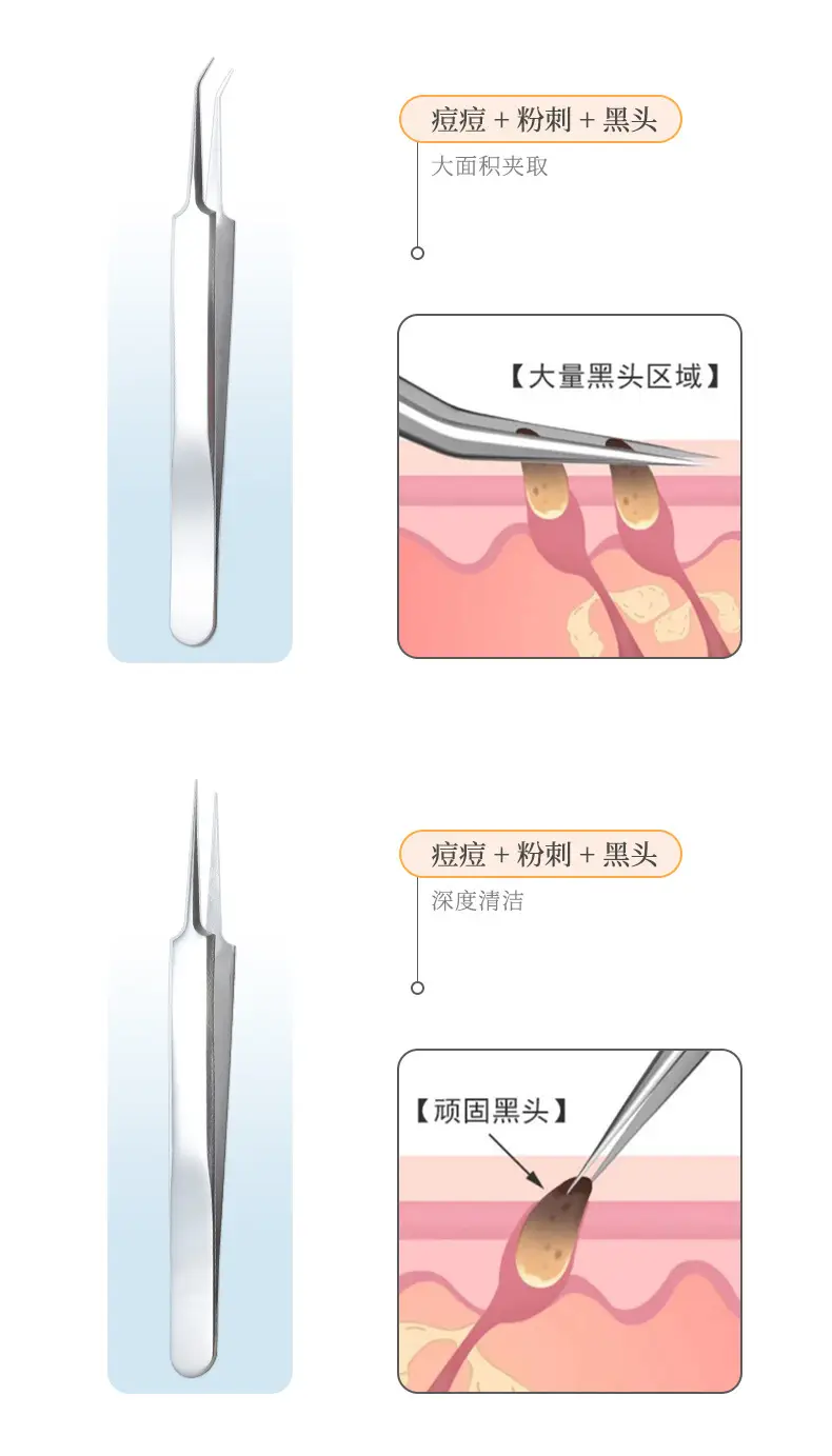 Lamera Acne Clip Cell for Blackhead Removal Salon Tools — feature 8