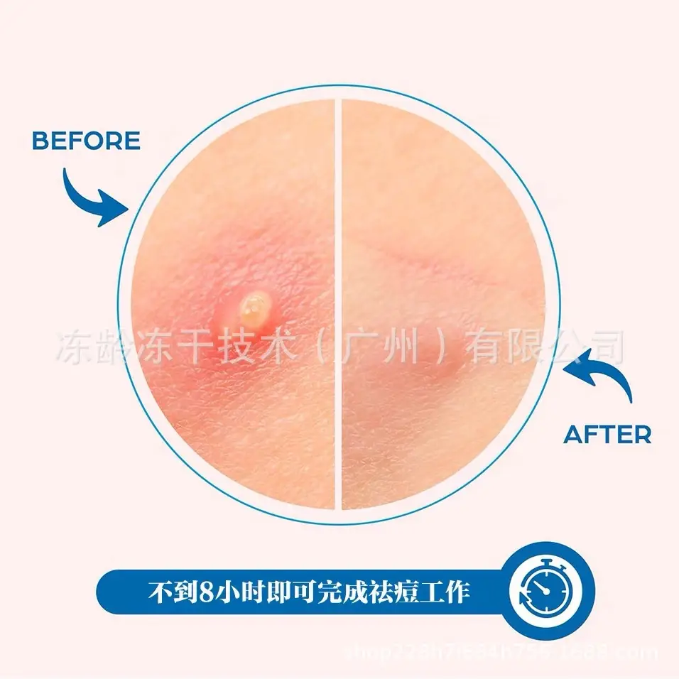 Invisible Acne Patch for All Skin Types — feature 10