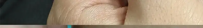 Nano Glass Hair Remover Patch for All Skin Types — feature 14