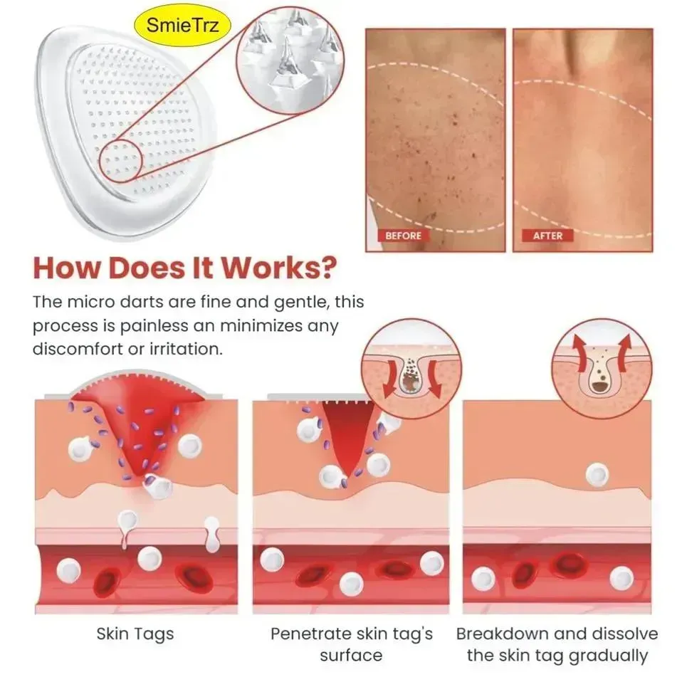 DermaSmooth Skin Tag Remover Patch 72 Pcs Cotton Red