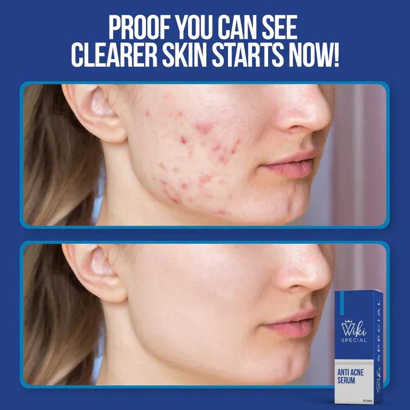 Wiki Anti-Acne Serum for Pakistani Skin Types
