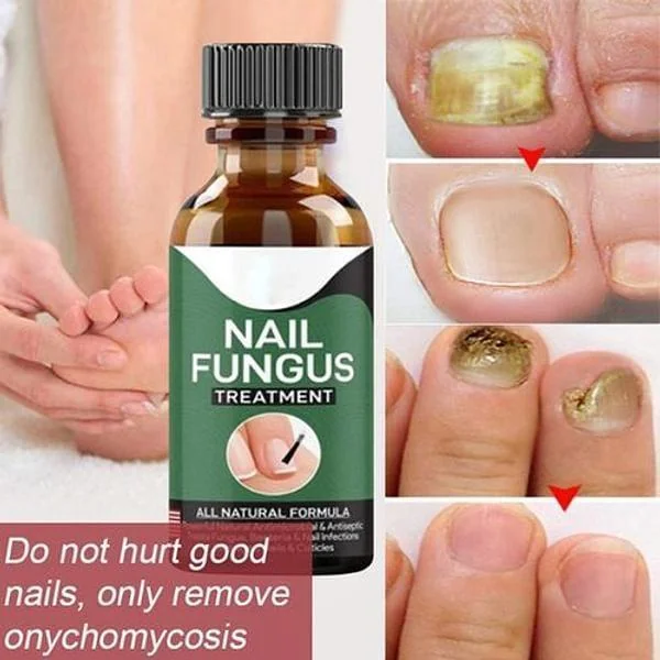 All Natural Nail Fungus Treatment Serum 1pc