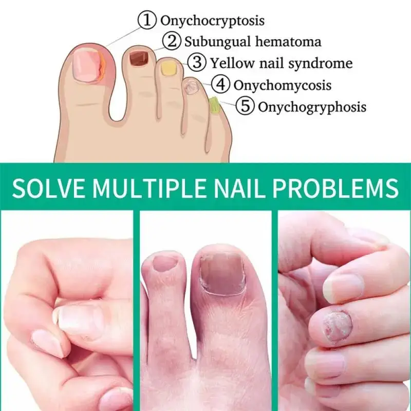 Fast Nail Fungal Treatments Nail Repair Essences Serum Care Treatments Foot Nail Fungus