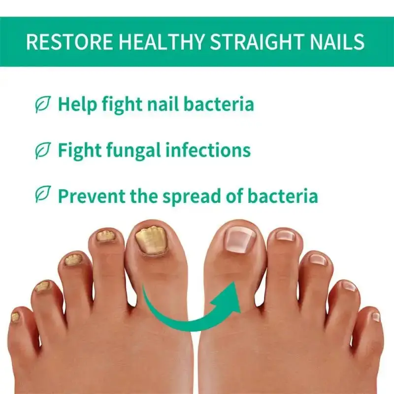 Fast Nail Fungal Treatments Nail Repair Essences Serum Care Treatments Foot Nail Fungus