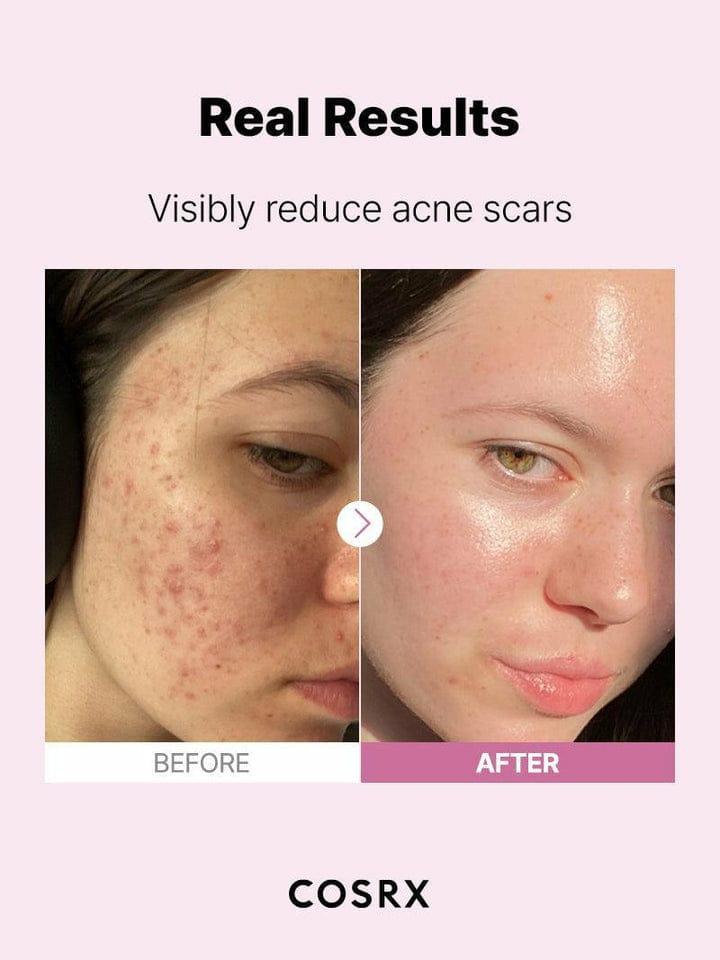 Niacinamide Serum 20ml Anti-Acne Even Tone