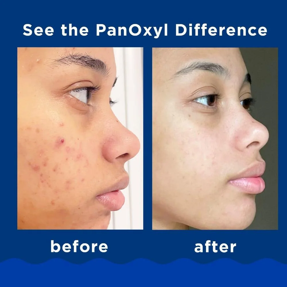 PanOxyl Acne Creamy Wash 4% Benzoyl Peroxide 170g