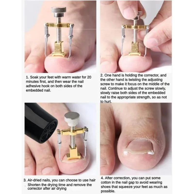 Ingrown Nail Correction Tool Golden Metal Travel Size