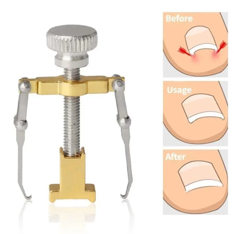 Ingrown Nail Correction Tool Golden Metal Travel Size