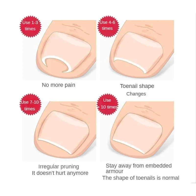 Ingrown Nail Correction Tool Golden Metal Travel Size