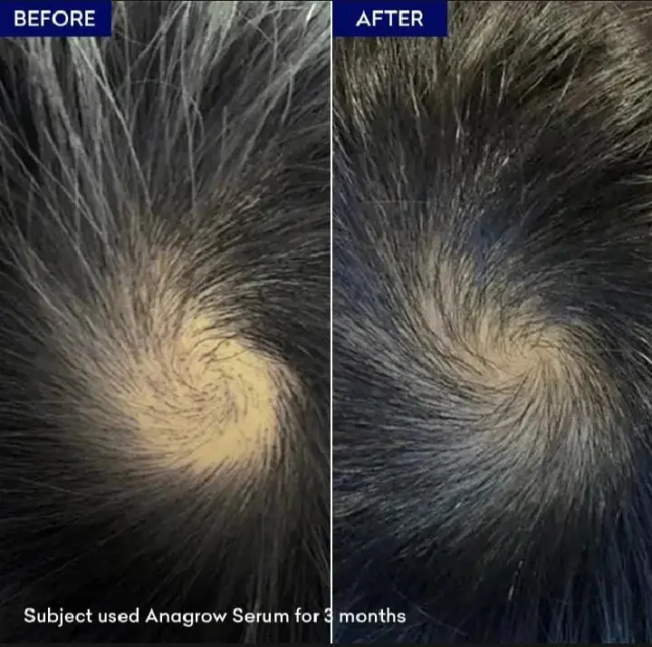 Anagrow Hair Growth Serum