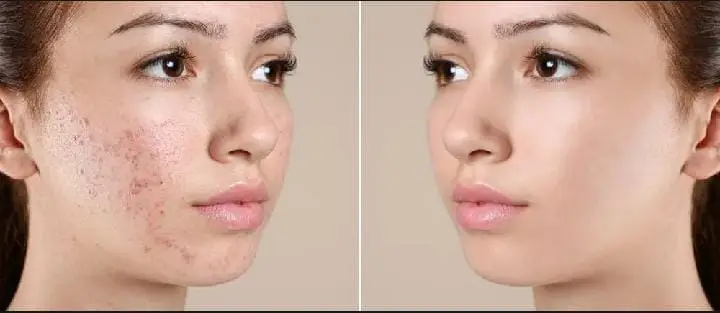 Skin-A Cream