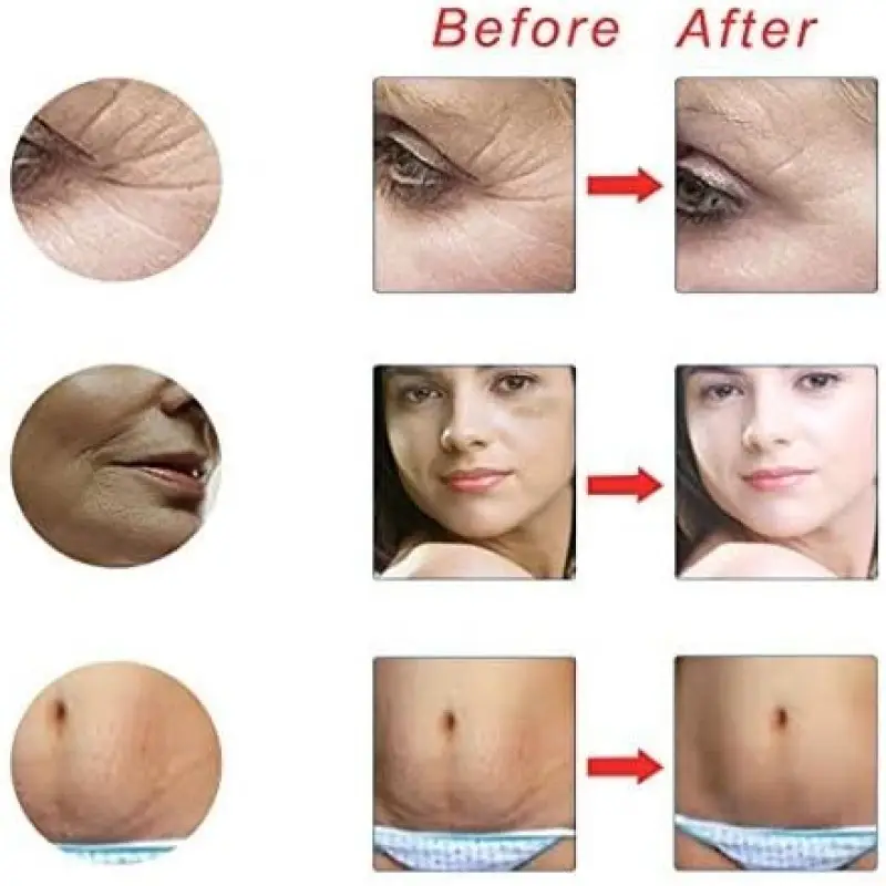 4 in 1 Derma Roller For Skin Therapy | Facial Derma Roller