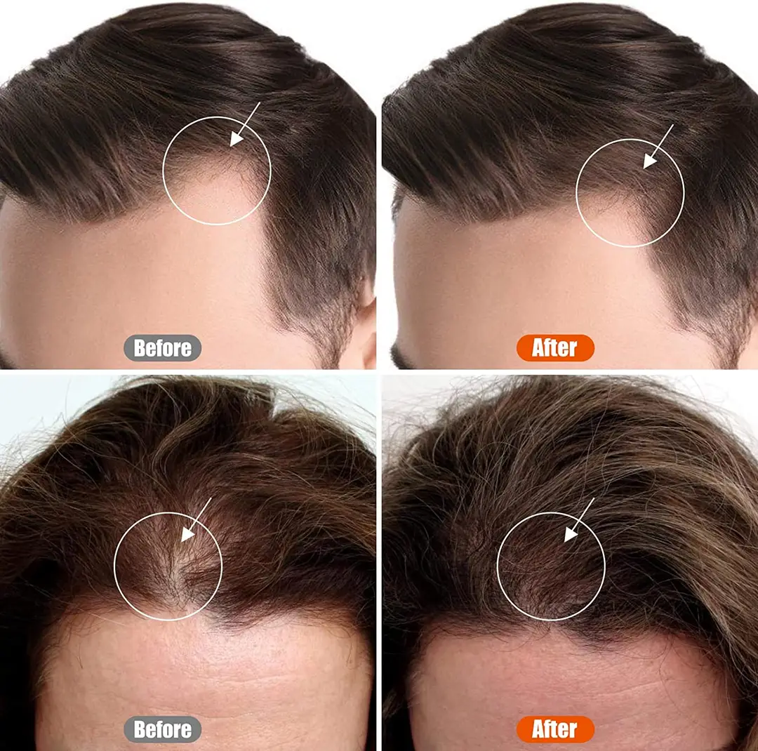 Derma Roller System for Hair & Skin 0.5 Mm 540
