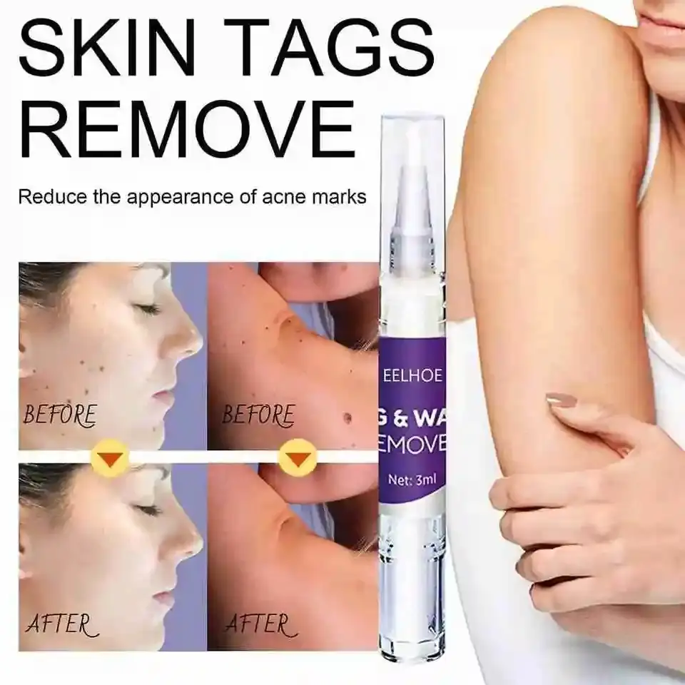 Skin Tag Mole Wart Remover Pen