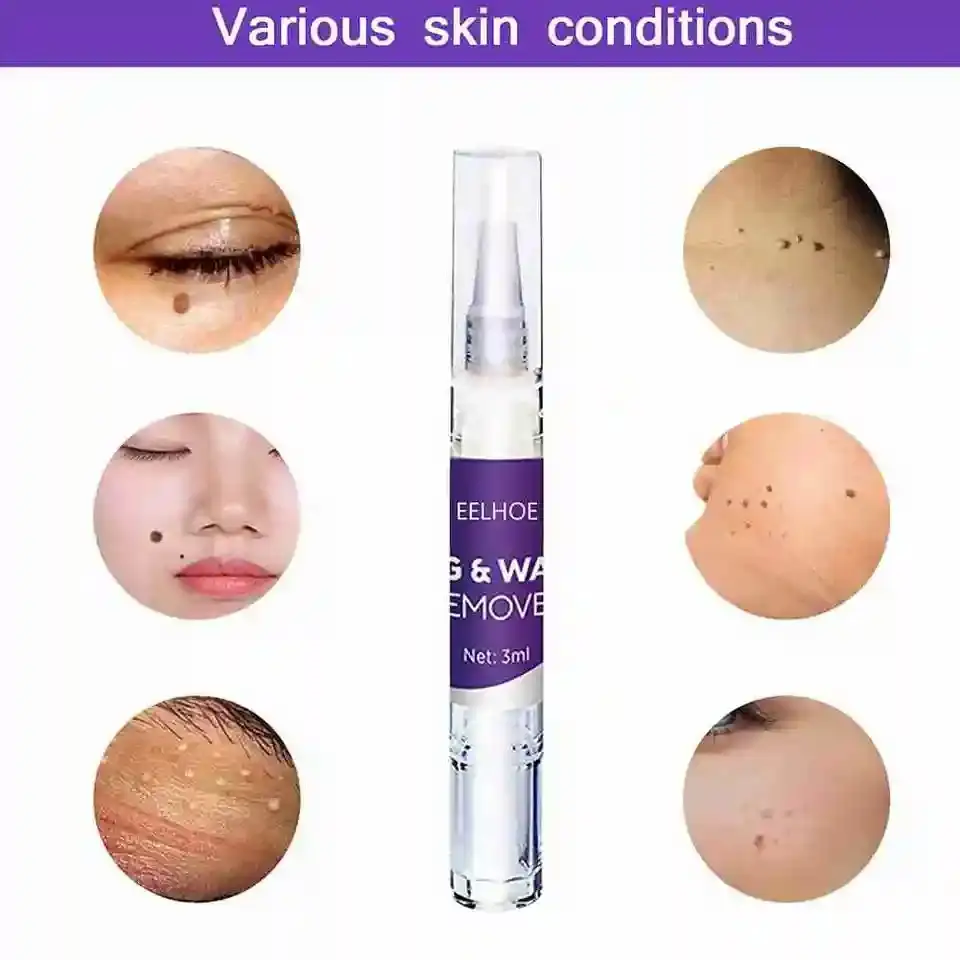 Skin Tag Warts Mole Remover Pen