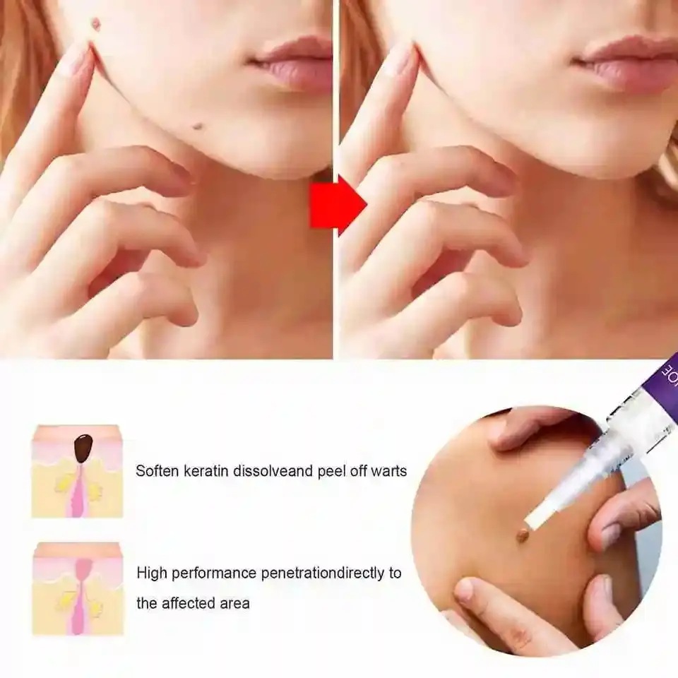 Skin Tag Warts Mole Remover Pen