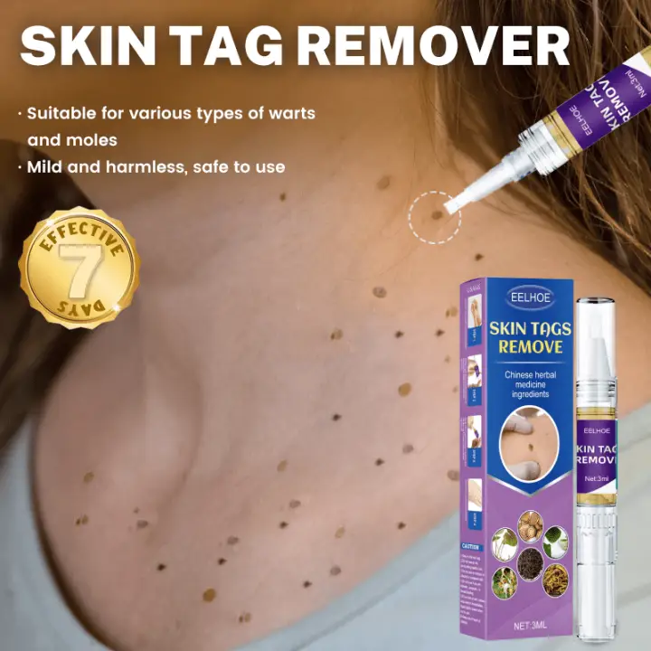 Skin Tag Warts Mole Remover Stick