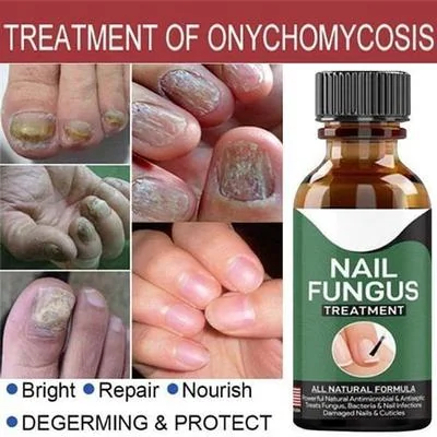 All Natural Nail Fungus Treatment Serum 1pc thumbnail 3