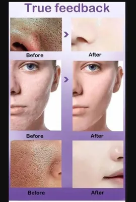 Pore Refining Serum 50ml for Even Skin Tone thumbnail 3