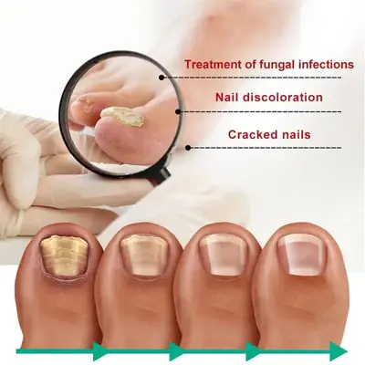 Fast Nail Fungal Treatments Nail Repair Essences Serum Care Treatments Foot Nail Fungus thumbnail 2