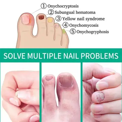Fast Nail Fungal Treatments Nail Repair Essences Serum Care Treatments Foot Nail Fungus thumbnail 3