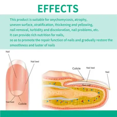 Fast Nail Fungal Treatments Nail Repair Essences Serum Care Treatments Foot Nail Fungus thumbnail 4