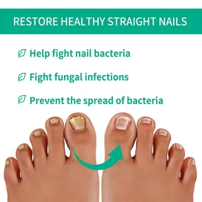 Fast Nail Fungal Treatments Nail Repair Essences Serum Care Treatments Foot Nail Fungus thumbnail 5