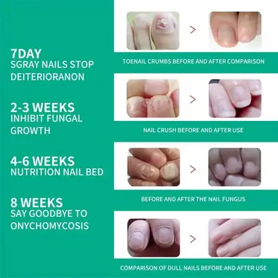 Fast Nail Fungal Treatments Nail Repair Essences Serum Care Treatments Foot Nail Fungus thumbnail 6