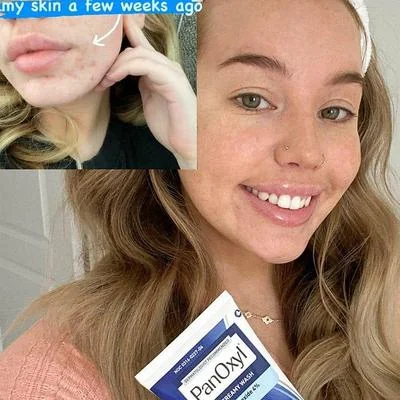 PanOxyl Acne Creamy Wash 4% Benzoyl Peroxide 170g thumbnail 3