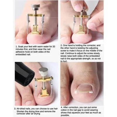 Ingrown Nail Correction Tool Golden Metal Travel Size thumbnail 5