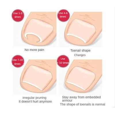 Ingrown Nail Correction Tool Golden Metal Travel Size thumbnail 7