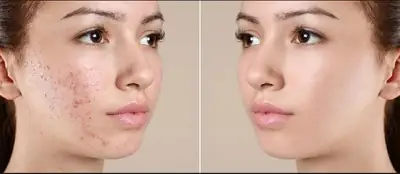 Skin-A Cream  thumbnail 3