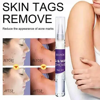 Skin Tag Warts Mole Remover Stick